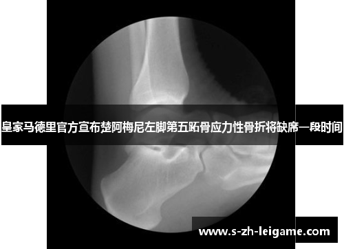 皇家马德里官方宣布楚阿梅尼左脚第五跖骨应力性骨折将缺席一段时间